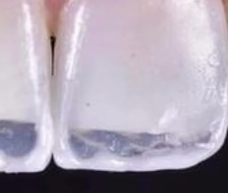Bordes incisales antes del tratamiento