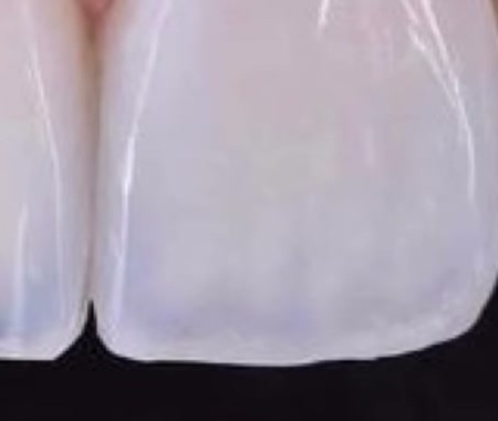 Bordes incisales después del tratamiento