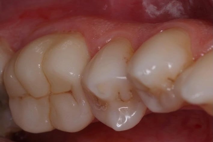 Fotografía clínica del molar antes de la rehabilitación