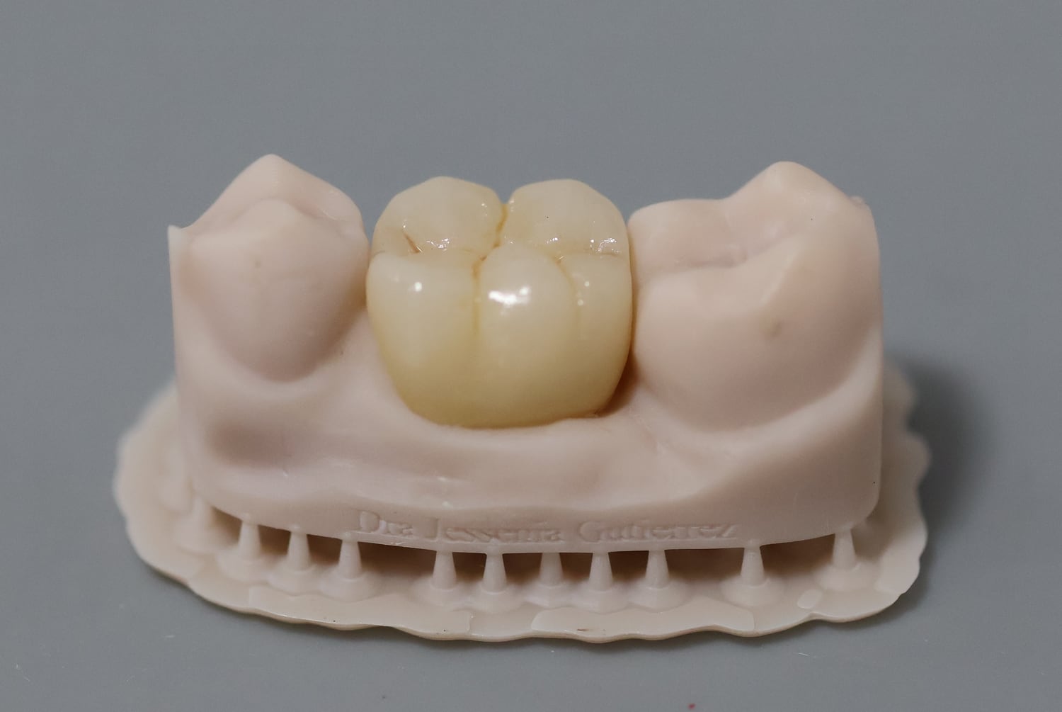 Modelo con la corona terminada sobre el molar rehabilitado